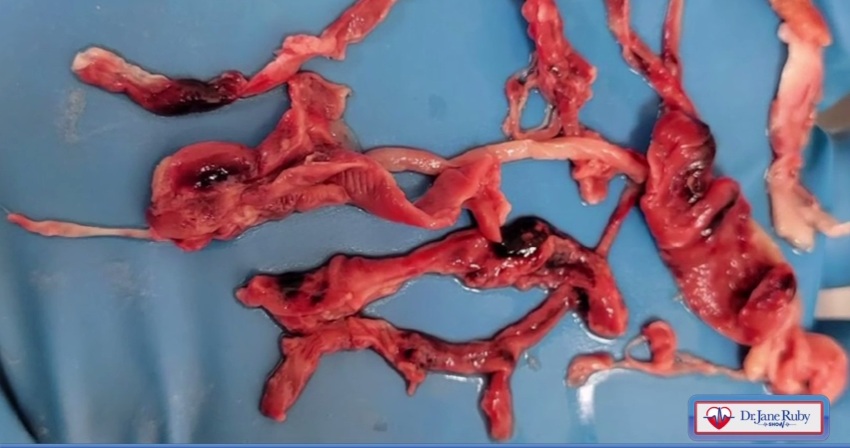 Einbalsamierer
                  Hirschmann zeigt weisses Faserblutgerinnsel 03
                  (7'58'')