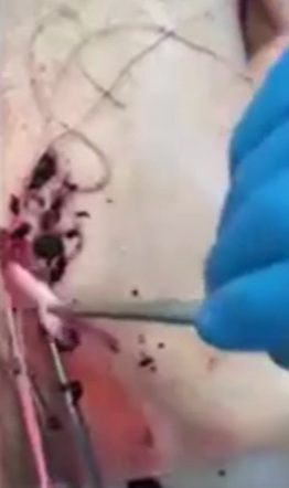 Einbalsamierer Hirschmann zieht 1 weisses
                  Faserblutgerinnsel aus der Beinvene eines Toten