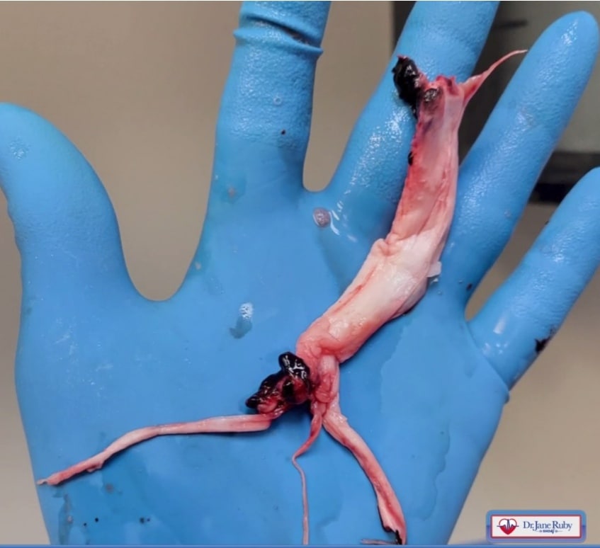 SCHLANGENGIFTimpfschaden
                                    "USA" 13.5.2022: Weisses
                                    Faserblutgerinnsel von
                                    Einbalsamierer Richard Hirschmann