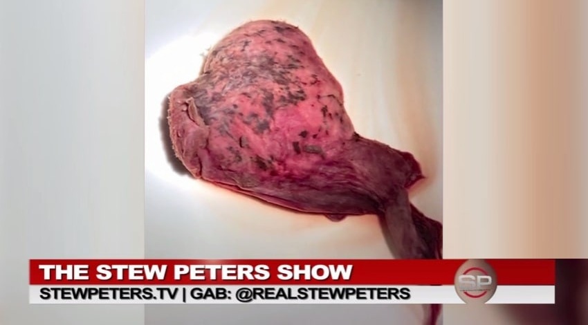 Shedding "USA" 13.5.2022: Akupunkteurin
                  Ananda hatte Shedding mit 4 Monate lang Menstruation
                  und gigantischen Blutgerinnseln