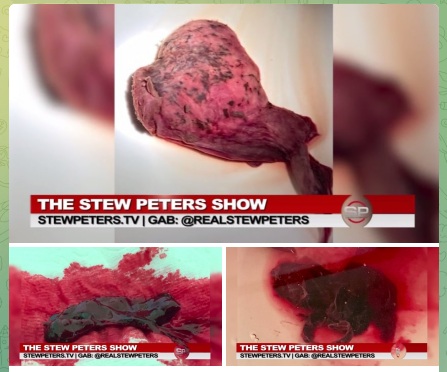 Shedding "USA" 13.5.2022:
                    Akupunkteurin Ananda hatte Shedding mit 4 Monate
                    lang Menstruation und gigantischen Blutgerinnseln