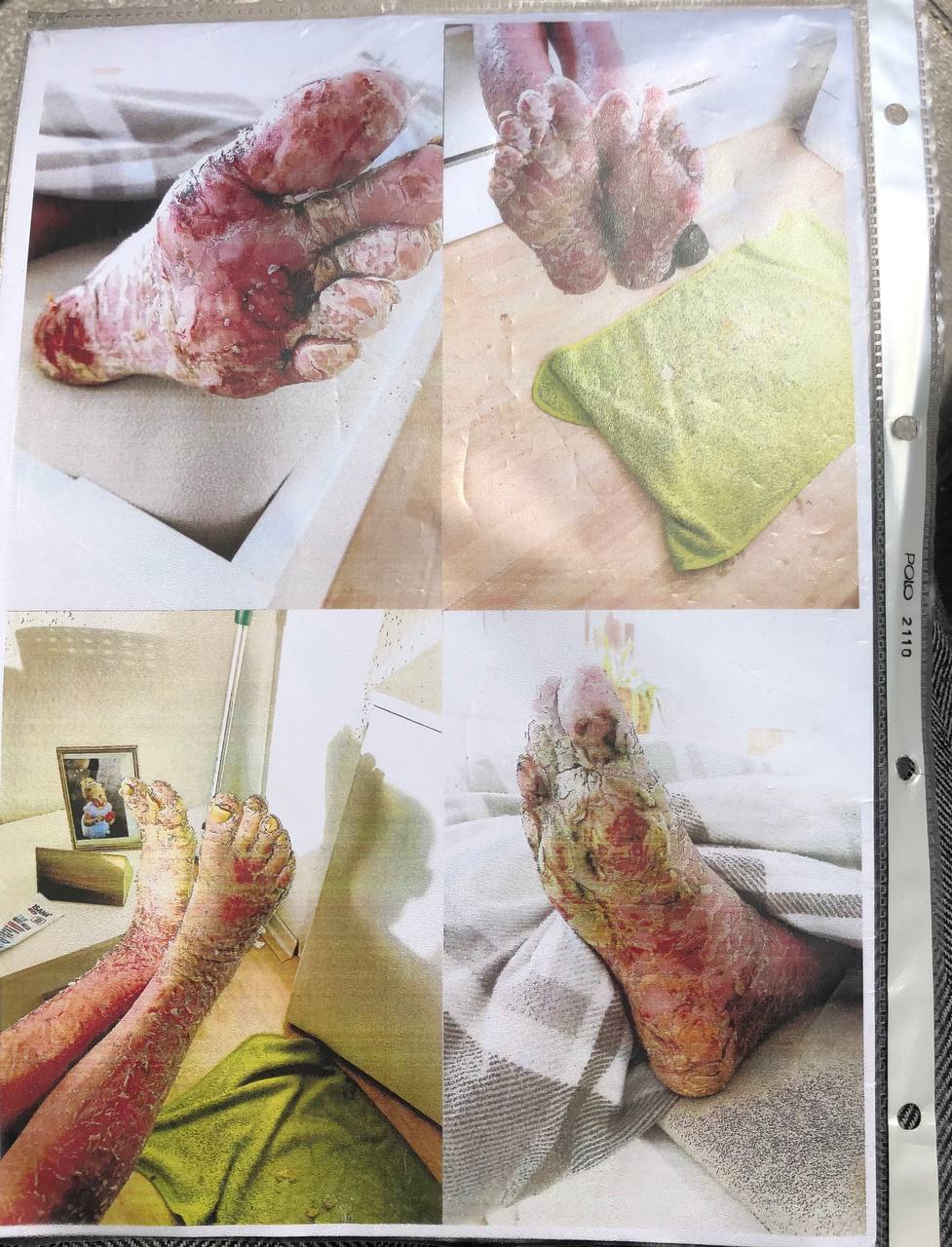 SCHLANGENGIFTimpfschaden Magdeburg
                  27.5.2022: Mann Pfizer geimpft: 2 Schlaganf�lle + Haut
                  l�st sich auf