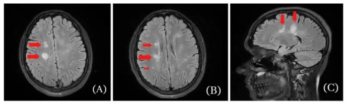 MS kommt wieder nach der
                      SCHLANGENGIFTimpfung, Fl�ssigkeitsblasen im Hirn