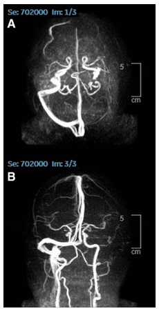 Sinusvenenthrombose 2 R�ntgenfotos