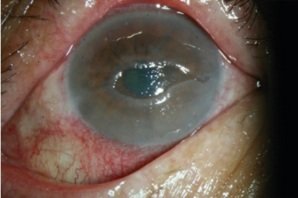 Augenschaden nach
                  SCHLANGENGIFTimpfung: Neurothrophes Geschw�r