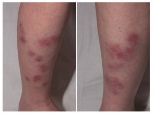 SCHLANGENGIFTimpfschaden
                  Beinthrombosen mit Knotenbildung