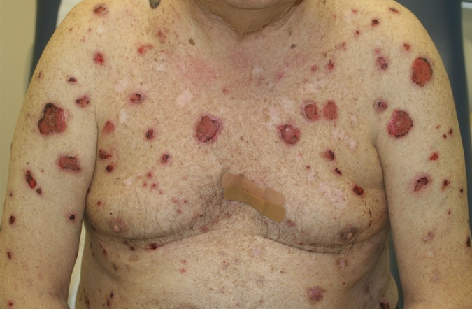 SCHLANGENGIFTimpfschaden mit Hautschaden
                  "Bull�ses Pemphigoid"