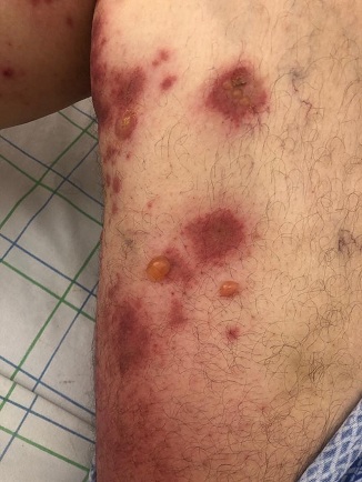 Hautsch�den durch SCHLANGENGIFTimpfung in
                  Kalifornien ("USA") 4.6.2022: 5 F�lle 01