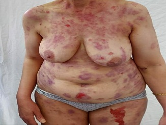 Hautsch�den durch SCHLANGENGIFTimpfung in
                  Kalifornien ("USA") 4.6.2022: 5 F�lle 04b