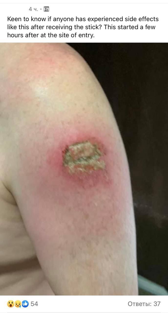 SCHLANGENGIFTimpfschaden D-A-CH 12.6.2022:
                  Impfarm geht kaputt - Fotos 01