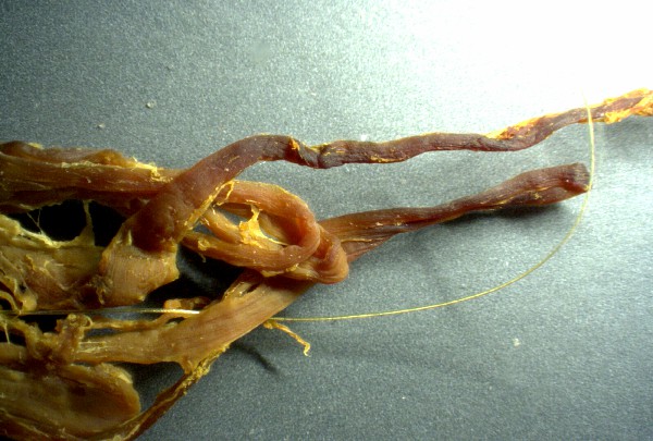 Oranges Blutgerinnsel mit Draht 01