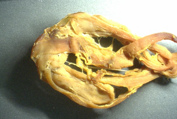 Gelbes
                    Blutgerinnsel 01