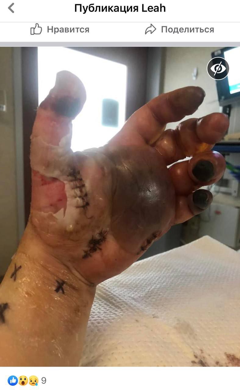 SCHLANGENGIFTimpfschaden ohne Ort 15.6.2022: Hand
                  fault ab mit Gangr�n