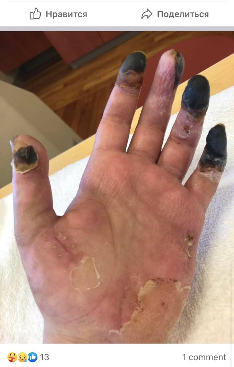 SCHLANGENGIFTimpfschaden ohne Ort 15.6.2022: Hand
                  fault ab mit Gangr�n