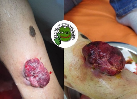 D-A-CH 18.7.2022: Mann
                    wahrscheinlich geimpft: bekommt Geschw�r -
                    wegoperiert - nun kommt Krebsgeschw�r