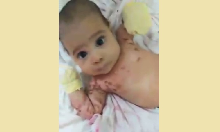 SCHLANGENGIFTimpfung gegen
                    Kinder in Brasilien 31.7.2022: Baby bekommt vom
                    Stillen Hautblasen �berall