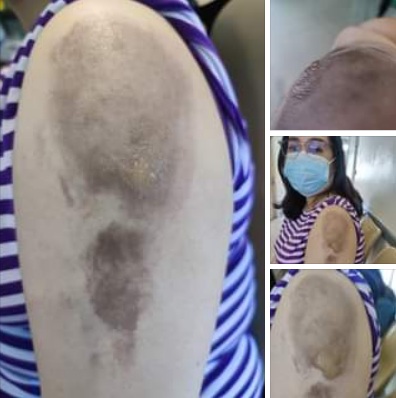 SCHLANGENGIFTimpfschaden Thailand 1.8.2022:
                  Impfarm wird eitrig mit riesigen Flecken