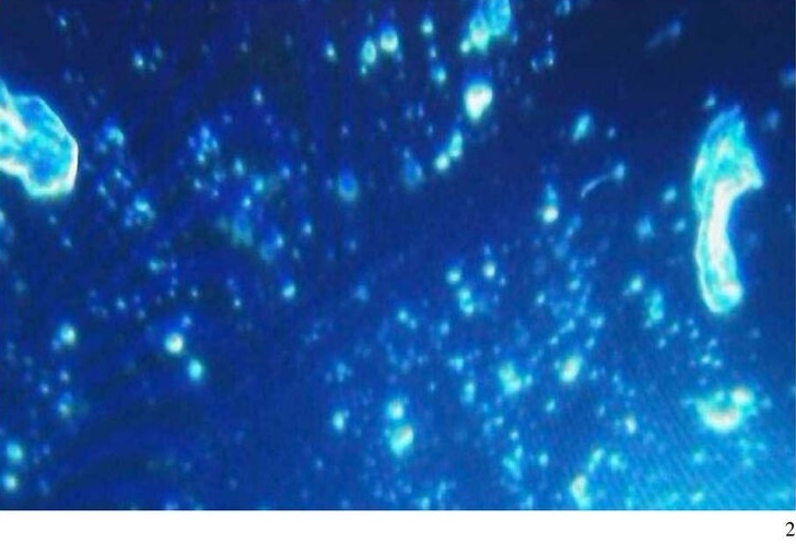 Italien: Mann mit
                      Pfizer mit Blutschaden: 2 Partikel und
                      Fibrinkn�uel