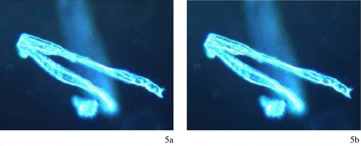 Mann mit Pfizer hat Blutschaden:
                      faserartig+r�hrenf�rmige Strukturen im Blut, Fotos
                      5a+b