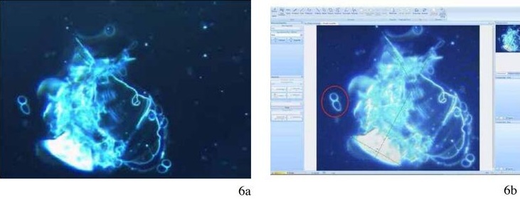 Mann in Italien mit Pfizerhat Blutschaden:
                      Partikel im Blut ist am sich Zusammensetzen