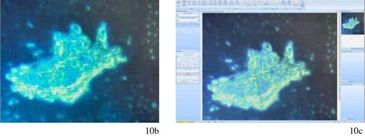 Italien: Mann mit Pfizer-Impfschaden im Blut:
                      Hier hat sich 5 Wochen nach der Impfung ein
                      "volumin�ses Agglomerat" gebildet