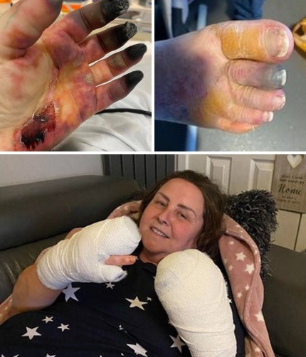 SCHLANGENGIFTimpfschaden Schottland 23.8.2022:
                    Frau komplett "geimpft": Finger schwarz -
                    8 Finger amputiert: Vollst�ndig geimpfte Frau l�sst
                    sich aufgrund einer "mysteri�sen
                    Krankheit" 8 Finger amputieren