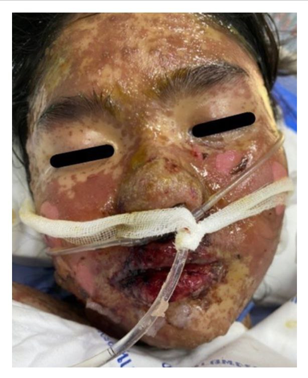 SCHLANGENGIFTimpfschaden ohne Ort, wahrsch.
                "USA" oder S�dkorea 29.8.2022: M�dchen (12) 1x
                Pfizer geimpft: Hautabl�sung von 40%