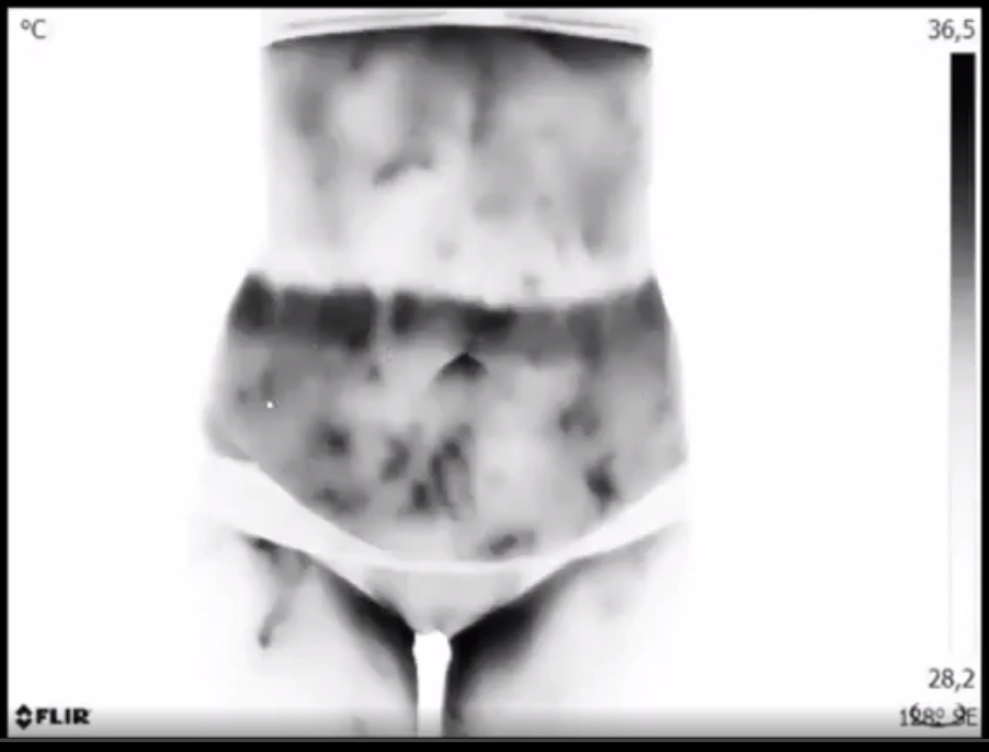 Der
                  Reitz-Ganzk�rper-Scan zeigt Thrombosen am ganzen
                  K�rper, Bauchbereich 2: Frau