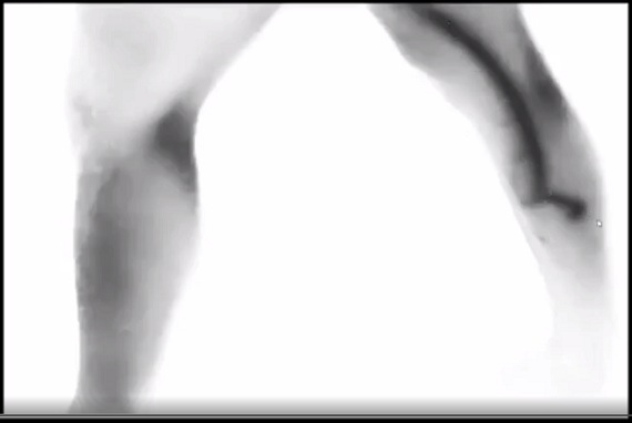 Der
                        Reitz-Ganzk�rper-Scan zeigt Thrombosen am ganzen
                        K�rper, Bein 05