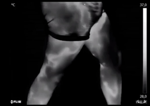 Der Reitz-Ganzk�rper-Scan
                  zeigt Thrombosen am ganzen K�rper, Bein 02