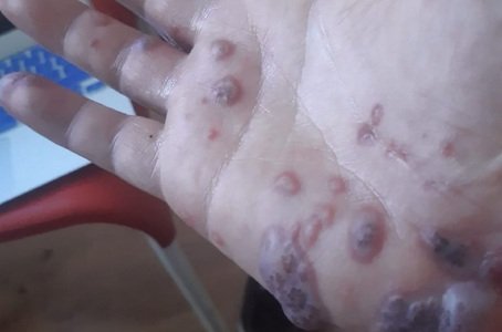 SCHLANGENGIFTimpfschaden
                  Schweiz 28.8.2022: Leute 3+4x geimpft haben
                  haufenweise Wunden von den H�nden aus am ganzen
                  K�rper, sind "negativ" auf Affenpocken
                  getestet - Tests zeigen KEINE Bakterien oder Viren an