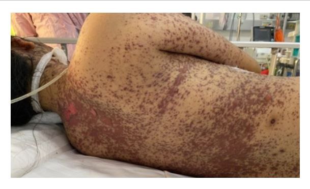 SCHLANGENGIFTimpfschaden ohne Ort, wahrsch.
                "USA" oder S�dkorea 29.8.2022: M�dchen (12) 1x
                Pfizer geimpft: Hautabl�sung von 40%