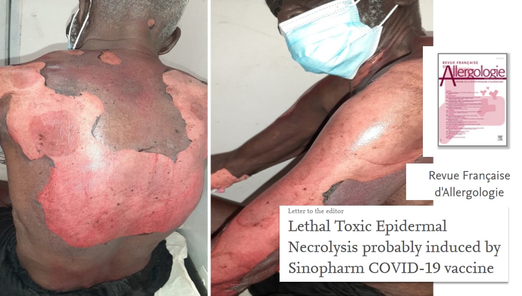 SCHLANGENGIFTimpfschaden ohne Ort 6.9.2022: Foto
Haut am Rücken und am Arm weg: Epidermische Nekrolyse
(Hautauflosung) SCHLANGENGIFTimpfschaden ohne Ort
6.9.2022: Foto Haut am Rücken und am Arm weg:
Epidermische Nekrolyse (Hautauflosung)