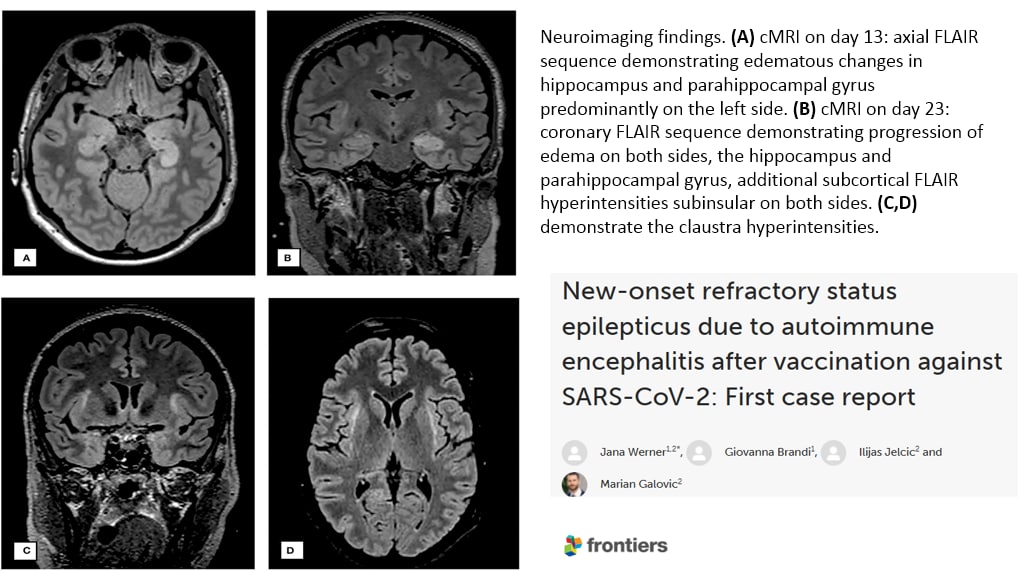 SCHLANGENGIFTimpfschaden ohne Ort 6.9.2022:
                    Hirnschaden Epilepsie nach Hirnhautentz�ndung nach
                    "Coronaimpfung"