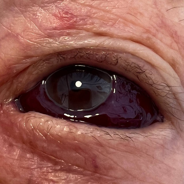 Verdacht SCHLANGENGIFTschaden ohne Ort 31.8.2022:
                  Auge wird schwarz durch Niesen