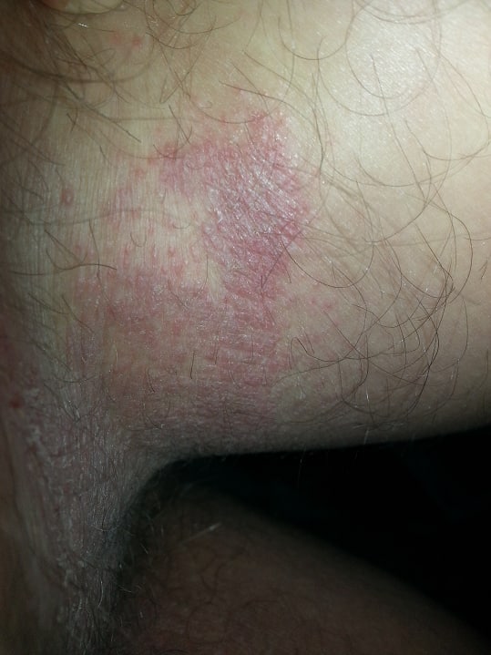 Verdacht Shedding Schweiz 3.10.2022: G�rtelrose
                  am Bein nach 3 Stunden Zug fahren mit der SBB