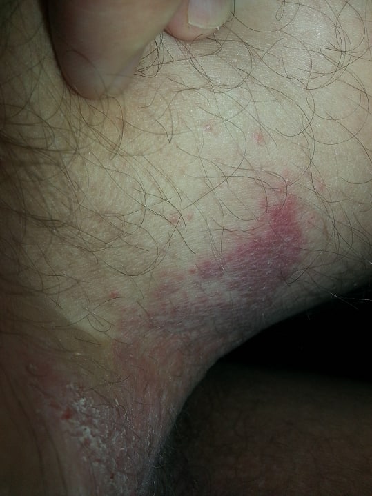 Verdacht Shedding Schweiz 3.10.2022: G�rtelrose
                  am Bein nach 3 Stunden Zug fahren mit der SBB, Foto 2