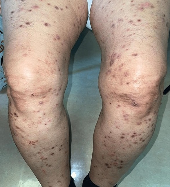 Saudi-Arabien: Kn�tchenkrankheit Prurigo
                          Nodularis