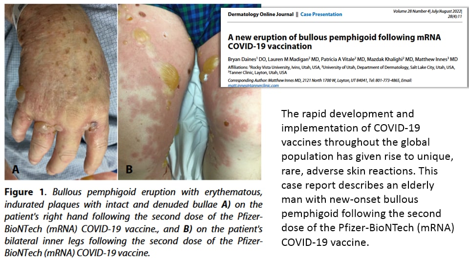 SCHLANGENGIFTimpfschaden Utah ("USA")
                  22.10.2022: Ausschlag mit Blasen