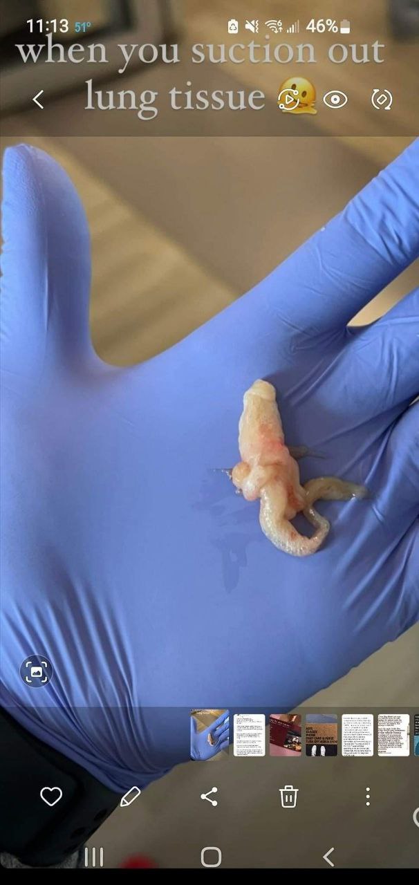 SCHLANGENGIFTimpfschaden Schweiz 19.10.2022:
                  Weisses Faserblutgerinnsel gefunden