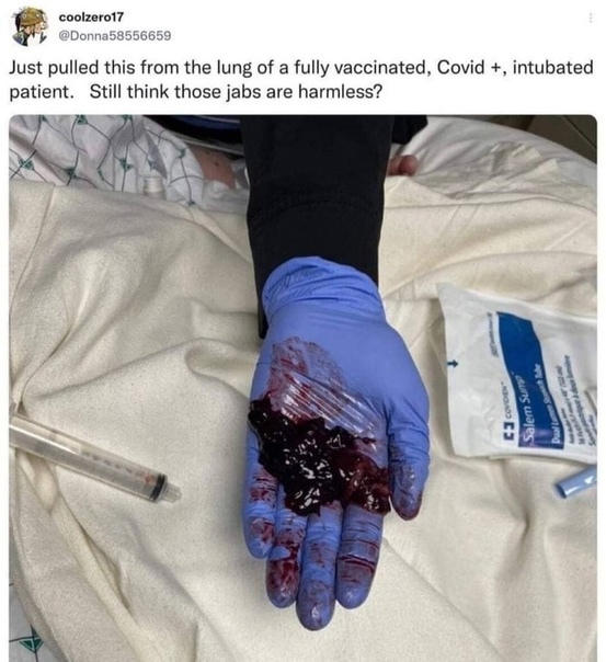 "Corona"-Impfschaden "USA"?
                  31.10.2022: Blutgerinnsel aus der Lunge eines
                  Geimpften, der nicht mehr atmen konnte