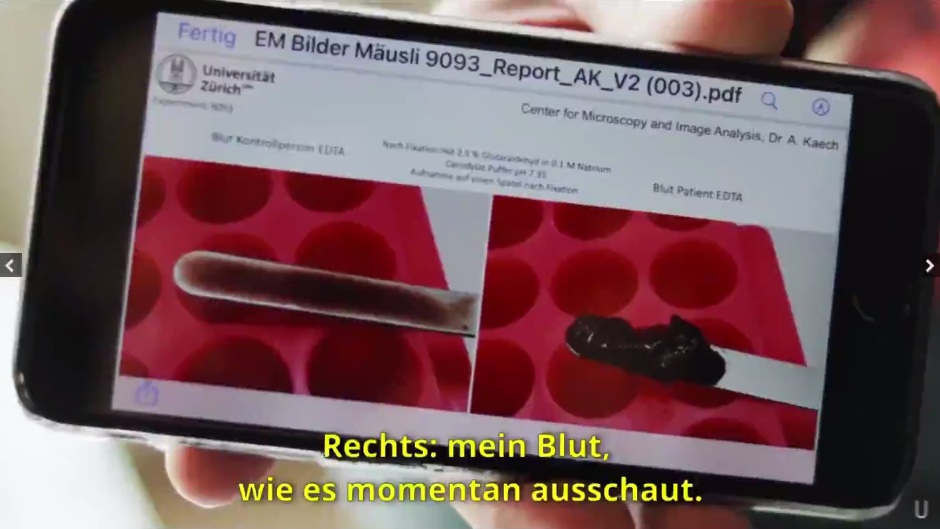 "Corona"-Impfschaden
                                  Schweiz 17.11.2022: Herr M�usli 2x
                                  geimpft hat ab 2 Wochen nach der 2.
                                  Impfung brennende
                                  Haut+thrombosenartiges Blut