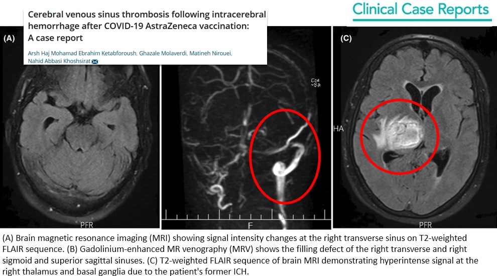 "Corona"-Impfschaden irgendwo
                    20.11.2022: Person mit
                    AstraZeneca-"Coronaimpfung" bekommt 2
                    Wochen sp�ter Sinusvenenthrombose: Cerebral venous
                    sinus thrombosis following intracerebral hemorrhage
                    after COVID-19 AstraZeneca vaccination: A case
                    report