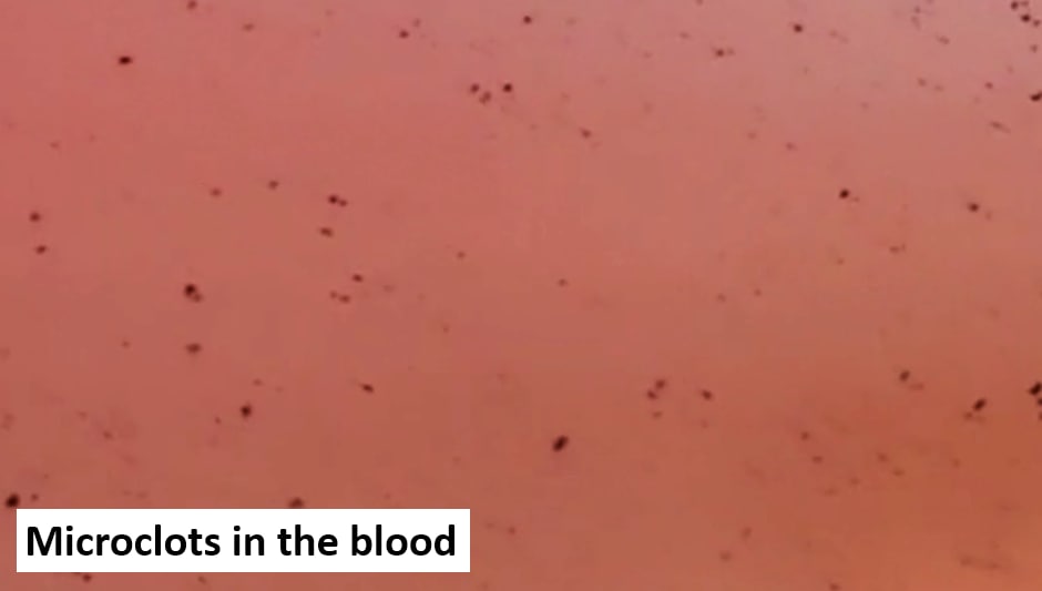 Blutschaden 27.11.2022: Mikrothrombosen im
Blut Blutschaden 27.11.2022: Mikrothrombosen
im Blut