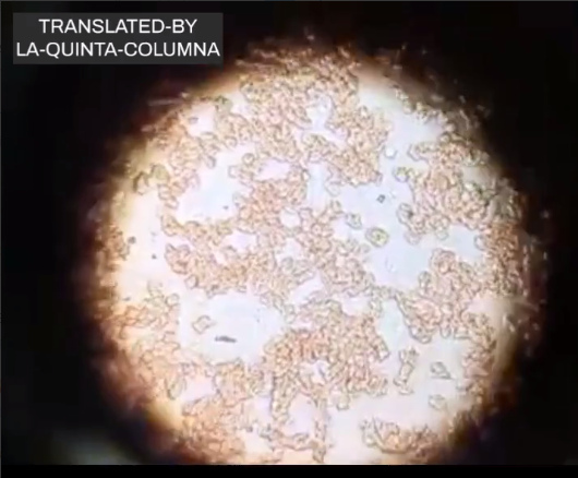 Geimpfte Person wahrsch. aus
                    Argentinien: Blutprobe unter dem Mikroskop,
                    Blutschaden gestapelte rote Blutk�rperchen und
                    Fremdk�rper im Blut 1