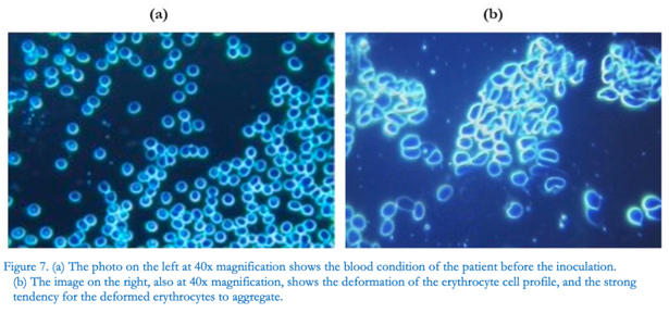 Intaktes Blut VOR der
"Coronaimpfung" (links) - Blutschaden
durch "Coronaimpfung" mit Zusammenballung
der roten Blutkörperchen (rechts) Intaktes
Blut VOR der "Coronaimpfung" (links) -
Blutschaden durch "Coronaimpfung" mit
Zusammenballung der roten Blutkörperchen (rechts)