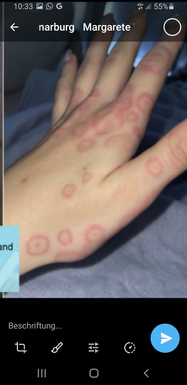 Kanton Graub�nden 26.1.2024:
                    Eine Person meint, sie sei w�hrend einer OP gegen
                    "Corona" geimpft worden - laufend
                    Ausschlag jetzt