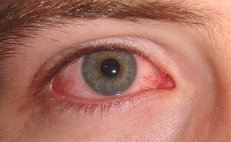 Konjunktivitis (Bindehautentz�ndung) kann
                        man gem�ss Dr. Peter D'Adamo mit Tomatenscheiben
                        behandeln