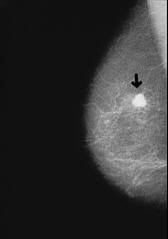 El
                          organismo del grupo sangu�neo AB est� propenso
                          a la mayor�a de las clases de c�ncer como el
                          grupo sangu�neo A
