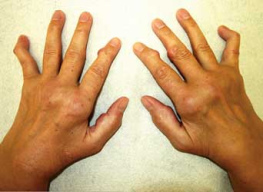 Rheumatoide
            Arthritis (hier mit angeschwollenen Fingergrundgelenken, mit
            Rheumaknoten an Fingergelenken und mit deformierten kleinen
            Fingern) ist je nach Blutgruppe verschieden